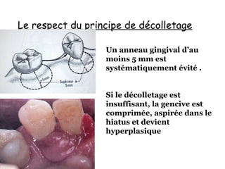 Le respect du principe de décolletage
Un anneau gingival d’au
moins 5 mm est
systématiquement évité .
Si le décolletage est
insuffisant, la gencive est
comprimée, aspirée dans le
hiatus et devient
hyperplasique
 