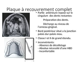 Plaque à recouvrement complet
• Partie antérieure repose sur le
cingulum des dents restantes:
Préparation des dents.
Décharge au niveau de
l’anneau gingival.
• Bord postérieur situé a la jonction
palais dur-palais mou.
• Classe I et II de grand étendu.
• Inconvénients:
- Absence de décolletage
- Absolue nécessité d’une HBD
- Inconfortable
 