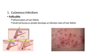 1. Cutaneous Infections
• Folliculitis
Inflammation of hair follicle
Small red bump or pimple develops at infection sites of hair follicle
 
