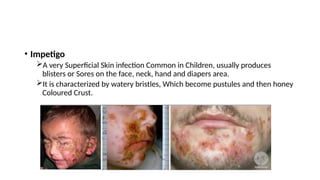 • Impetigo
A very Superficial Skin infection Common in Children, usually produces
blisters or Sores on the face, neck, hand and diapers area.
It is characterized by watery bristles, Which become pustules and then honey
Coloured Crust.
 