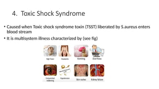 4. Toxic Shock Syndrome
• Caused when Toxic shock syndrome toxin (TSST) liberated by S.aureus enters
blood stream
• It is multisystem illness characterized by (see fig)
 