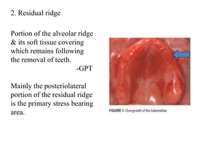 1. Maxillary-Landmarks PROSTHODONTICS .ppt
