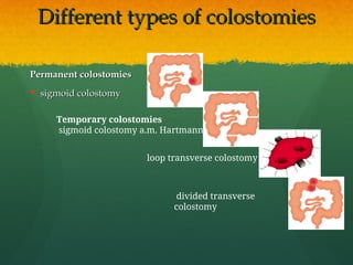 1. indikasi, teknik pembuatan stoma, reanastomosisppt.ppt