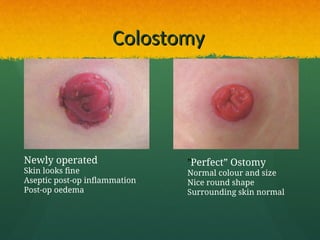 Normal Ostomy Color 1. indikasi, teknik pembuatan stoma, reanastomosisppt.ppt