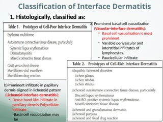 Classification of Interface Dermatitis
b)Prominent infiltrate in papillary
dermis aligned in lichenoid pattern
(Lichenoid-interface dermatitis):
• Dense band-like infiltrate in
papillary dermis-Polycellular
infiltrate
•Basal cell vacuolization may
be
1. Histologically, classified as:
a) Prominent basal cell vacuolization
(Vacuolar-interface dermatitis):
• Basal cell vacuolization is most
prominent
• Variable perivascular and
interstitial infiltrates of
lymphocytes.
• Paucicellular infiltrate
 