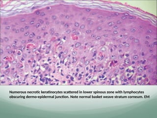Numerous necrotic keratinocytes scattered in lower spinous zone with lymphocytes
obscuring dermo-epidermal junction. Note normal basket weave stratum corneum. EM
 