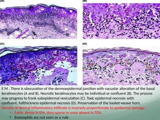 E M . There is obscuration of the dermoepidermal junction with vacuolar alteration of the basal
keratinocytes (A and B). Necrotic keratinocytes may be individual or conﬂuent (B). The process
may progress to frank subepidermal vesiculation (C). Toxic epidermal necrosis with
conﬂuent, fullthickness epidermal necrosis (D). Preservation of the basket-weave horn.
Density of dermal inflammatory infiltrate is inversely proportionate to epidermal damage.
• Fairly dense in EM, Very sparse or even absent in TEN.
• Eosinophils are not seen as a rule
 