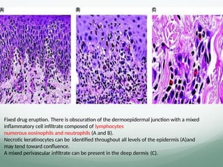 Fixed drug eruption. There is obscuration of the dermoepidermal junction with a mixed
inﬂammatory cell inﬁltrate composed of lymphocytes
numerous eosinophils and neutrophils (A and B).
Necrotic keratinocytes can be identiﬁed throughout all levels of the epidermis (A)and
may tend toward conﬂuence.
A mixed perivascular inﬁltrate can be present in the deep dermis (C).
 