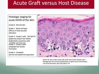 Spongiosis
Satellite cell necrosis
 