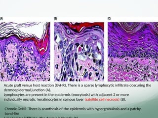 Acute graft versus host reaction (GvHR). There is a sparse lymphocytic inﬁltrate obscuring the
dermoepidermal junction (A).
Lymphocytes are present in the epidermis (exocytosis) with adjacent 2 or more
individually necrotic keratinocytes in spinous layer (satellite cell necrosis) (B).
Chronic GvHR. There is acanthosis of the epidermis with hypergranulosis and a patchy
band-like
 