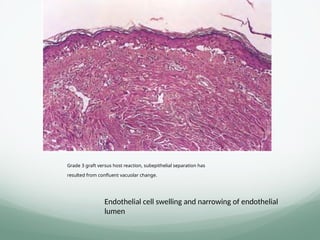 Grade 3 graft versus host reaction, subepithelial separation has
resulted from confluent vacuolar change.
Endothelial cell swelling and narrowing of endothelial
lumen
 