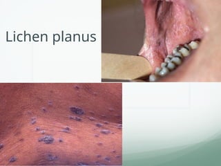Lichen planus
 
