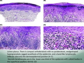Lichen planus. There is compact orthokeratosis with no parakeratosis, wedgeshaped
hypergranulosis, jagged acanthosis of the epidermis, and a band-like lymphocytic
inﬁltrate obscures the dermoepidermal junction (A–C).
Necrotic keratinocytes are in the lower one-third of the epidermis with colloid bodies in
the superﬁcial papillary dermis (D)
 