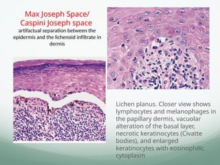 Max Joseph Space/
Caspini Joseph space
artifactual separation between the
epidermis and the lichenoid infiltrate in
dermis
Lichen planus. Closer view shows
lymphocytes and melanophages in
the papillary dermis, vacuolar
alteration of the basal layer,
necrotic keratinocytes (Civatte
bodies), and enlarged
keratinocytes with eosinophilic
cytoplasm
 