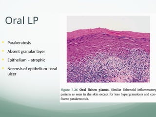 Oral LP
 Parakeratosis
 Absent granular layer
 Epithelium – atrophic
 Necrosis of epithelium –oral
ulcer
 