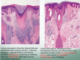 Lichen planopilaris.flask like dilated follicular
infuldibula with compact keratin - Follicular
plugging, hypergranulosis, and dense,
bandlike perifollicular lymphocytic infiltrate
(destroys bulge cells ) that obscures the
infundibular epithelium
Lichen planopilaris, developed lesion.
Perifollicular fibrosis and inflammation with
epithelial atrophy at the infundibuloisthmic
portion give rise to an hourglass
configuration.loss of follicles
 