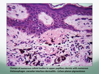 Clumps of numerous colloid bodies in upper papillary dermis with numerous
Melanophages ,vacuolar interface dermatitis - Lichen planus pigmentosus
 