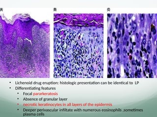 • Lichenoid drug eruption: histologic presentation can be identical to LP
• Differentiating features
• Focal pararkeratosis
• Absence of granular layer
• necrotic keratinocytes in all layers of the epidermis
• Deeper perivascular infiltate with numerous eosinophils ,sometimes
plasma cells
 