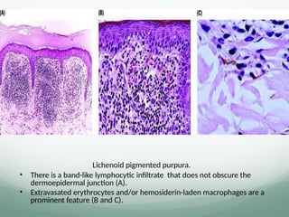 Lichenoid pigmented purpura.
• There is a band-like lymphocytic inﬁltrate that does not obscure the
dermoepidermal junction (A).
• Extravasated erythrocytes and/or hemosiderin-laden macrophages are a
prominent feature (B and C).
 