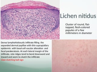 Dense lymphohistiocytic inﬁltrate ﬁlling the
expanded dermal papillae with thin suprapiallary
epidermis with basal cell vacular alteration and
focal parakeratosis. At each lateral margin of the
infiltrate, rete ridges tend to bend downward and
inward and seem to clutch the infiltrate
Claw clutching ball sign
Cluster of round, flat-
topped, flesh-colored
papules of a few
millimeters in diameter
.
Lichen nitidus
 
