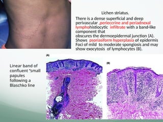 Lichen striatus.
• There is a dense superﬁcial and deep
perivascular ,perieccrine and periadnexal
lymphohistiocytic inﬁltrate with a band-like
component that
obscures the dermoepidermal junction (A).
Shows psoriasiform hyperplasia of epidermis
Foci of mild to moderate spongiosis and may
show exocytosis of lymphocytes (B).
Linear band of
confluent “small
papules
following a
Blaschko line
 