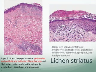 Lichen striatus
Closer view shows an infiltrate of
lymphocytes and histiocytes, exocytosis of
lymphocytes, acanthosis, spongiosis, and
focal parakeratosis
Superficial and deep perivascular, perieccrine,
and perifollicular infiltrate of lymphocytes and
histiocytes that extends to the epidermis,
which shows acanthosis and spongiosis
.
 