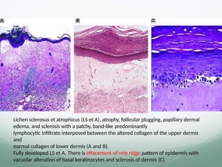 Lichen sclerosus et atrophicus (LS et A), atrophy, follicular plugging, papillary dermal
edema, and sclerosis with a patchy, band-like predominantly
lymphocytic inﬁltrate interposed between the altered collagen of the upper dermis
and
normal collagen of lower dermis (A and B).
Fully developed LS et A. There is effacement of rete ridge pattern of epidermis with
vacuolar alteration of basal keratinocytes and sclerosis of dermis (C)
 