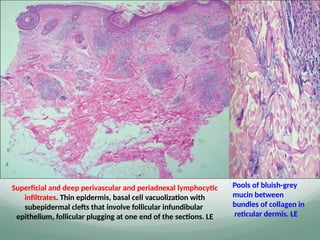 Superficial and deep perivascular and periadnexal lymphocytic
infiltrates. Thin epidermis, basal cell vacuolization with
subepidermal clefts that involve follicular infundibular
epithelium, follicular plugging at one end of the sections. LE
Pools of bluish-grey
mucin between
bundles of collagen in
reticular dermis. LE
 