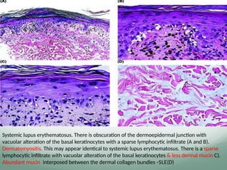 Systemic lupus erythematosus. There is obscuration of the dermoepidermal junction with
vacuolar alteration of the basal keratinocytes with a sparse lymphocytic inﬁltrate (A and B).
Dermatomyositis. This may appear identical to systemic lupus erythematosus. There is a sparse
lymphocytic inﬁltrate with vacuolar alteration of the basal keratinocytes & less dermal mucin C).
Abundant mucin interposed between the dermal collagen bundles -SLE(D)
 