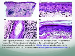 Discoid lupus erythematosus. There is a superﬁcial and deep perivascular and periadnexal
lymphocytic inﬁltrate with vacuolar alteration of the basal keratinocytes (A and B).
A dense lymphocytic inﬁltrate surrounds the follicular adnexae with obscuration of the
epithelial-stromal junction(C). Note the marked thickening of the basement membrane (D)
 