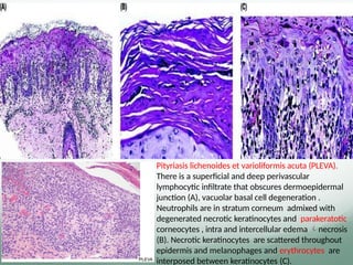 Pityriasis lichenoides et varioliformis acuta (PLEVA).
There is a superﬁcial and deep perivascular
lymphocytic inﬁltrate that obscures dermoepidermal
junction (A), vacuolar basal cell degeneration .
Neutrophils are in stratum corneum admixed with
degenerated necrotic keratinocytes and parakeratotic
corneocytes , intra and intercellular edema necrosis
(B). Necrotic keratinocytes are scattered throughout
epidermis and melanophages and erythrocytes are
interposed between keratinocytes (C).
 