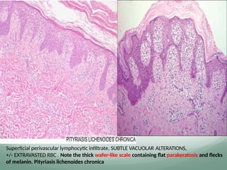Superficial perivascular lymphocytic infiltrate, SUBTLE VACUOLAR ALTERATIONS,
+/- EXTRAVASTED RBC . Note the thick wafer-like scale containing flat parakeratosis and flecks
of melanin. Pityriasis lichenoides chronica
 