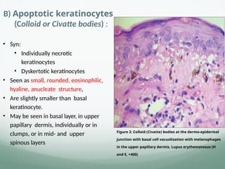 B) Apoptotic keratinocytes
(Colloid or Civatte bodies) :
• Syn:
• Individually necrotic
keratinocytes
• Dyskertotic keratinocytes
• Seen as small, rounded, eosinophilic,
hyaline, anucleate structure,
• Are slightly smaller than basal
keratinocyte.
• May be seen in basal layer, in upper
papillary dermis, individually or in
clumps, or in mid- and upper
spinous layers
Figure 2: Colloid (Civatte) bodies at the dermo‐epidermal
junction with basal cell vacuolization with melanophages
in the upper papillary dermis. Lupus erythematosus (H
and E, ×400)
 