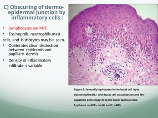 C) Obscuring of dermo-
epidermal junction by
inflammatory cells :
• Lymphocytes are M/C
• Eosinophils, neutrophils,mast
cells, and histiocytes may be seen.
• Obliterates clear distinction
between epidermis and
papillary dermis
• Density of inflammatory
infiltrate is variable
Figure 3: Several lymphocytes in the basal cell layer
obscuring the DEJ with basal cell vacuolization and few
apoptotic keratinocytes in the lower spinous zone.
Erythema multiforme (H and E, ×400)
 