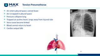 Tension Pneumothorax
Air enters pleural space; cannot leave
Air is trapped in pleural space
Pressure collapses lung
Trapped air pushes heart, lungs away from injured side
Vena cavae become kinked
Blood cannot return to heart
Cardiac output falls
29
 