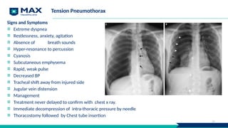 Tension Pneumothorax
Signs and Symptoms
Extreme dyspnea
Restlessness, anxiety, agitation
Absence of breath sounds
Hyper-resonance to percussion
Cyanosis
Subcutaneous emphysema
Rapid, weak pulse
Decreased BP
Tracheal shift away from injured side
Jugular vein distension
Management
Treatment never delayed to confirm with chest x ray.
Immediate decompression of intra-thoracic pressure by needle
Thoracostomy followed by Chest tube insertion
30
 