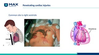 Common site is right ventricle
Penetrating cardiac injuries
 