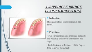 Maxillary sinus in periodontology .pptx