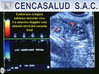 Embarazo ectópico
tubárico derecho vivo.
La muestra doppler esta
situada nivel del corazón
fetal
 