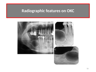 Odontogenic cysts Types histopathology and management | PPTX