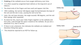 Nail Clubbing Algorithm 1. Cardiovascular System.pptx .............................. | PPTX