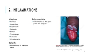 1 Pathology Of The MALE GENITAL TRACT PATHOLOGY pdf 1-pathology-of-the-male-genital-tract-pathology-pdf