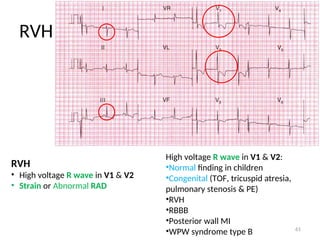 High Voltage R Complex CVS summary for medical students and residents | PPT
