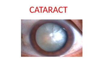 1.CATARACT INTRODUCTION AND DEVELOPMENTAL CATARACT.pptx