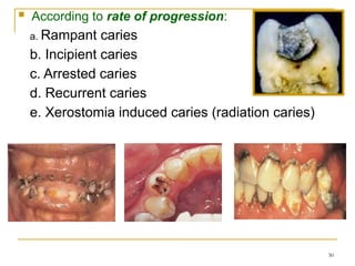 Comprehensive Overview of Dental Caries: Definitions, Classification ...
