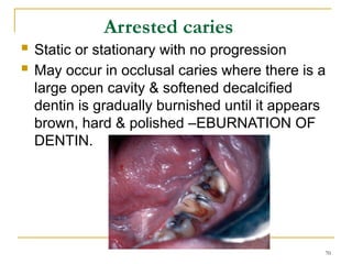 Static Caries Comprehensive Overview of Dental Caries: Definitions, Classification ...