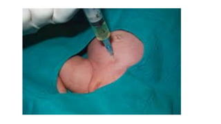 Comprehensive Guide to Foley Catheterization: Indications, Types, and ...
