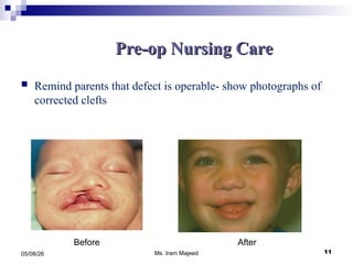 Comprehensive Nursing Care for Children with Cleft Lip and Palate | PPT