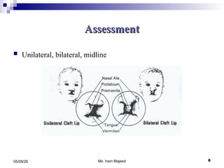 Comprehensive Nursing Care for Children with Cleft Lip and Palate | PPT