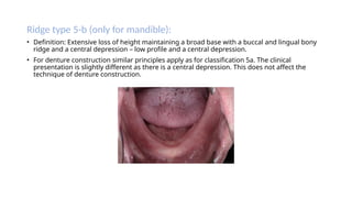Ridge Classification and Neutral Zone Technique in Prosthodontics | PPTX